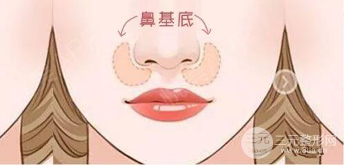 肋骨墊鼻基底會移位嗎