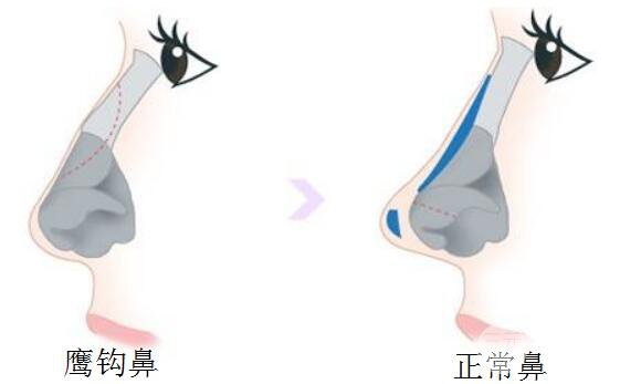 怎樣改變鷹鉤鼻子？整形方法有哪些？詳細整形術式解析