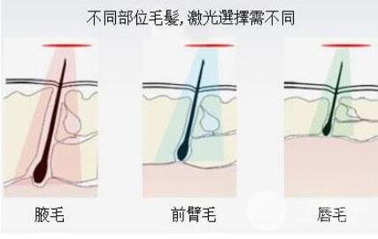 成都腋下激光脫毛的價(jià)格貴嗎?激光脫毛多少錢?