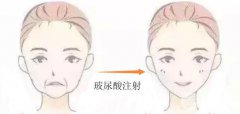 玻尿酸注射去皺費用是多少？價格差異在哪