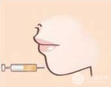 下巴注射物取出價(jià)格貴不貴？影響因素主要有？