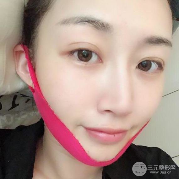 【術(shù)后3天即可上妝】大V.線 定點(diǎn)提拉 讓臉“嘭嘭嘭”！