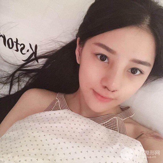 【隆鼻整形+進(jìn)口假體+耳軟骨墊鼻尖+鼻頭鼻翼縮小+鼻尖延長】綜合改良！