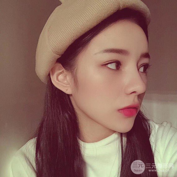 【隆鼻整形+進(jìn)口假體+耳軟骨墊鼻尖+鼻頭鼻翼縮小+鼻尖延長】綜合改良！