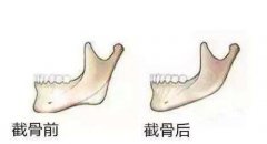 一般削骨大概多少錢？影響價(jià)格的因素有哪些？