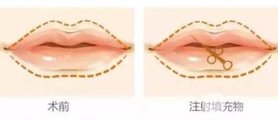玻尿酸豐唇整形手術(shù)要多少錢(qián)？?jī)r(jià)格影響在于？
