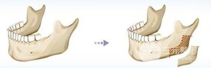 下頜角磨骨術(shù)恢復(fù)期要怎么保養(yǎng)、術(shù)后護(hù)理？