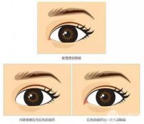 北京開內(nèi)眼角價格一般多少