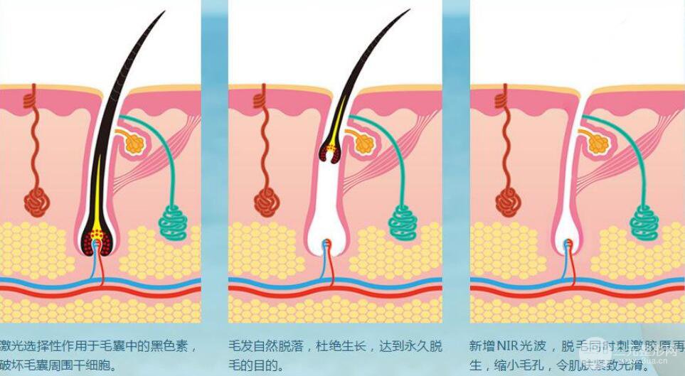半導(dǎo)體激光脫毛適應(yīng)癥有哪些呢?