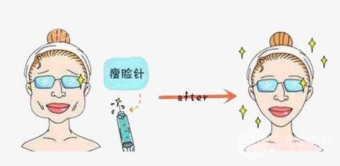 注射注射瘦臉瘦臉的副作用嚴(yán)重嗎？需要注意什么