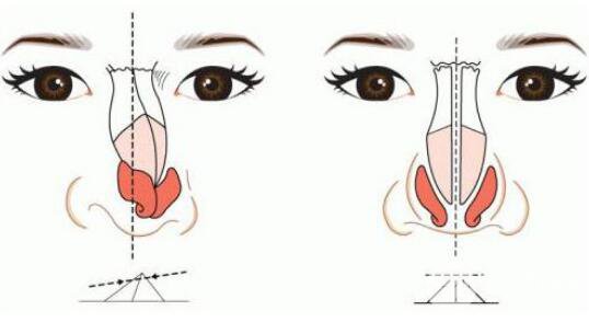 膨體材料隆鼻成好嗎?膨體隆鼻果怎么樣?
