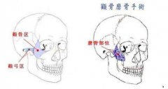 顴骨降低做完后需要多長時間恢復(fù)?