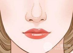 鼻翼寬怎么改良?鼻翼縮小的方法有哪些?