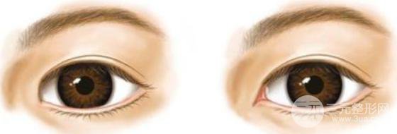 開眼角后容易留疤嗎？留疤了該怎么辦？