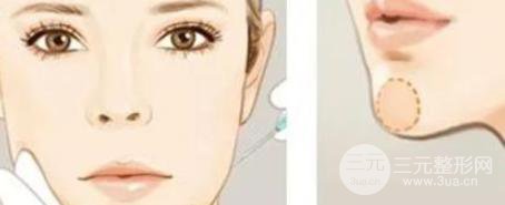 玻尿酸墊下巴打幾次能永.久？成好嗎？