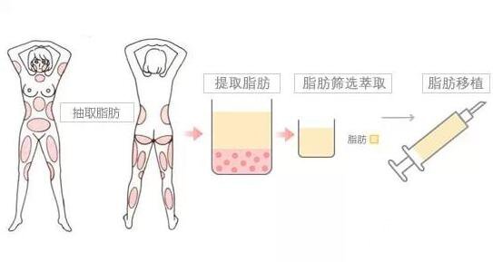 成都軍大醫(yī)院自體填充果好不好？收費(fèi)貴嗎？