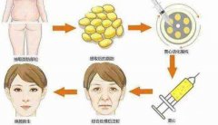 成都軍大自體脂肪填充術后如何護理果持久？