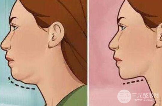 成都雙下巴吸脂價格多少?費用貴嗎?