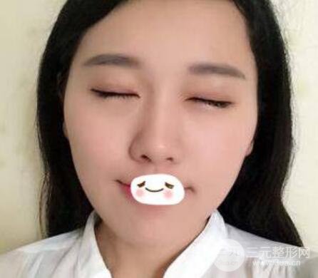 成都雙眼皮修復(fù)貴不貴？附真實(shí)案例及修復(fù)價格