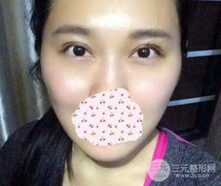 成都雙眼皮修復(fù)貴不貴？附真實(shí)案例及修復(fù)價格