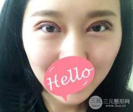 成都雙眼皮修復(fù)貴不貴？附真實(shí)案例及修復(fù)價格