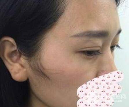 成都雙眼皮修復(fù)貴不貴？附真實(shí)案例及修復(fù)價格