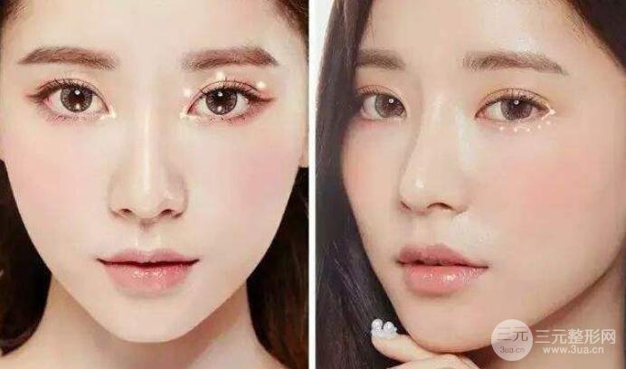 成都開內(nèi)外眼角分別是什么價格?哪個貴些?