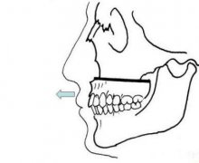 成都地包天矯正手術(shù)大概要好多錢?價格受影響多嗎?