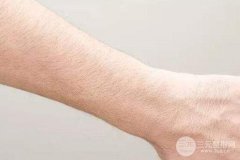 成都做激光脫毛手術(shù)費用一般在什么價位?