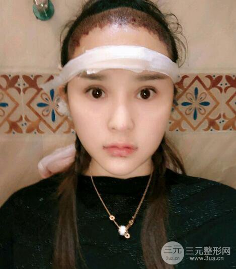 種發(fā)際線果圖