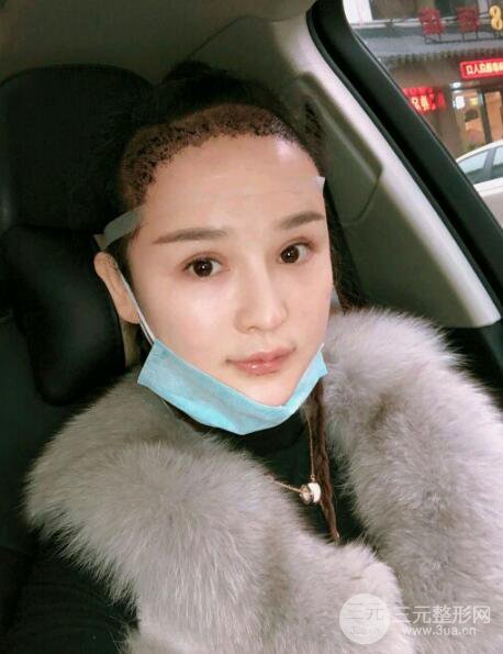 種發(fā)際線果圖