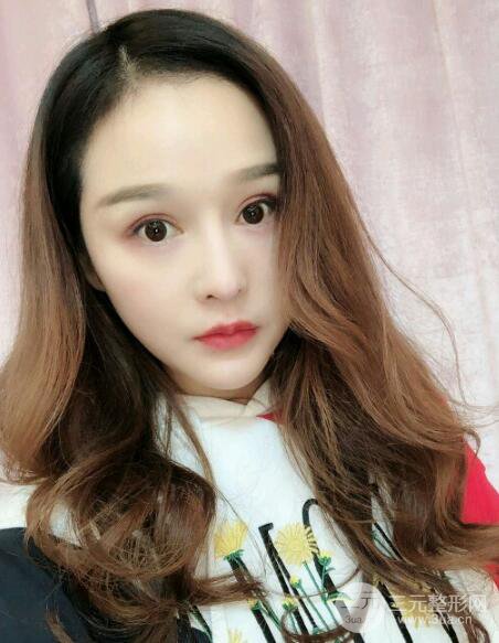 種發(fā)際線果圖