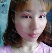 武漢希思特整形醫(yī)院雙眼皮修復(fù)前后對(duì)比照 術(shù)后84天 告別一單一內(nèi)雙不對(duì)稱(chēng)