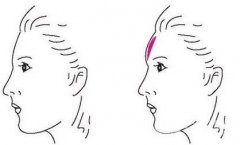 玻尿酸豐額頭降低風(fēng)險嗎？多久可以恢復(fù)