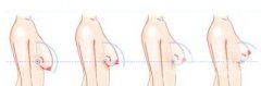 乳房下垂造成的原因？乳房下垂怎么矯正