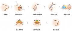 做硅膠隆鼻注意事項有哪些? 硅膠隆鼻手術(shù)圖片