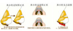 鼻小柱延長怎么做  鼻小柱延長用什么材料