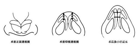 什么是鼻小柱延長(zhǎng) 鼻小柱可以延長(zhǎng)嗎