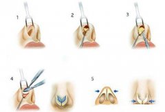 假體隆鼻手術過程  假體隆鼻后注意事項