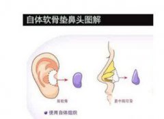 鼻中隔隆鼻和耳軟骨哪個好