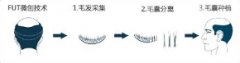 FUT植發(fā)什么原理?做FUT種植頭發(fā)會留疤嗎?