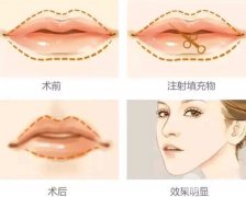 玻尿酸可以豐唇嗎  玻尿酸豐唇好不好