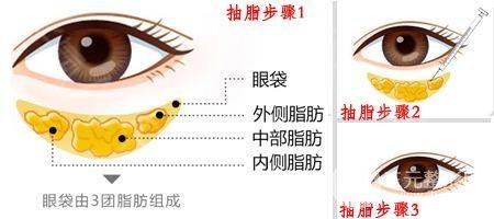 吸脂術(shù)去眼袋有無什么副作用