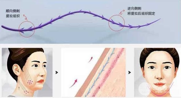 鋸齒線面b提升術(shù)多久見？果又能維持多久喃？