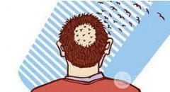 植發(fā)疼嗎，植發(fā)完什么時候不疼?