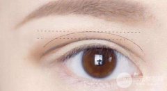 西安割雙眼皮修復(fù)大約多少錢(qián)，有哪些決定價(jià)格的因素?