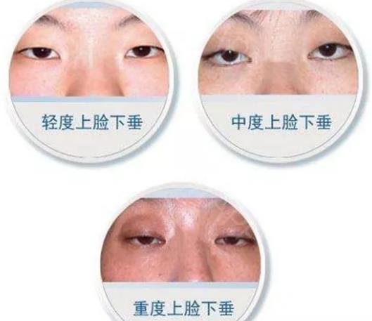 上瞼下垂修復(fù)