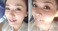 美容冠多少錢一顆，全口烤瓷真的不好嗎?