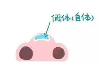骨膜下隆鼻整形手術(shù)怎么做的？哪種情況適合做？