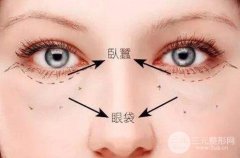 這些居然是自體脂肪豐臥蠶缺點(diǎn)，看完之后震驚了！